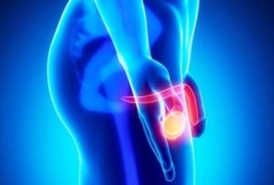 Фото: Двусторонняя гипоплазия яичек