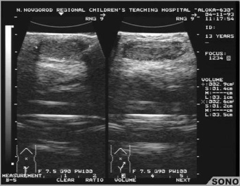 Фото: гипоплазия у мальчиков