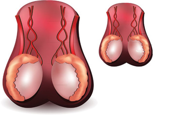 Фото:лечение гипоплазии у мужчин